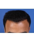 After Hair Transplant&nbsp;Front